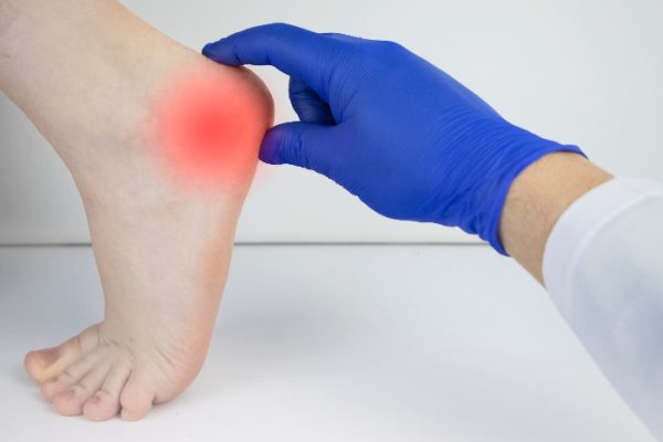 esporao-de-calcaneo-fisioterapia-instituto-trata-2